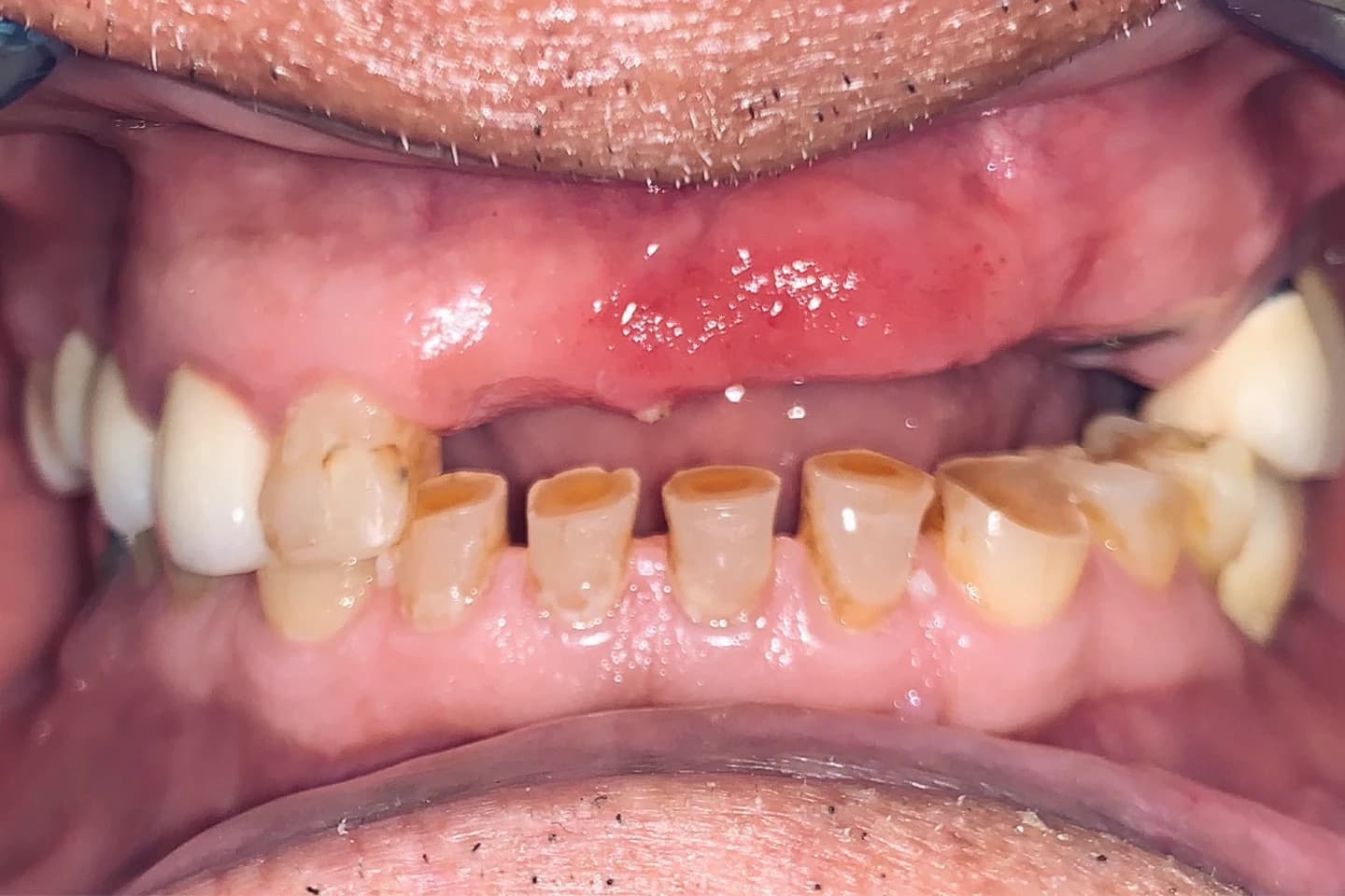 Aleksandar izgled pre hollywood smile tretmana