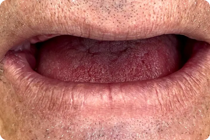 All-on-4 usluga na našem zadovoljnom pacijentu