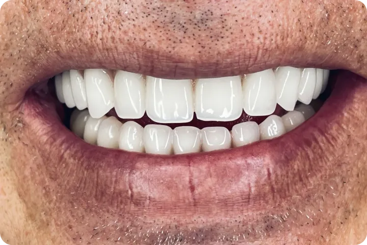 All-on-4 usluga na našem zadovoljnom pacijentu