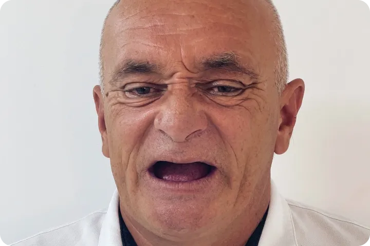 All-on-4 usluga na našem zadovoljnom pacijentu