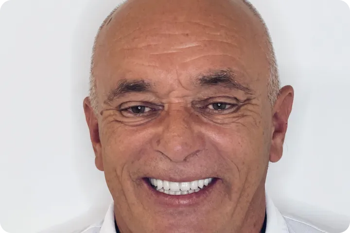 All-on-4 usluga na našem zadovoljnom pacijentu