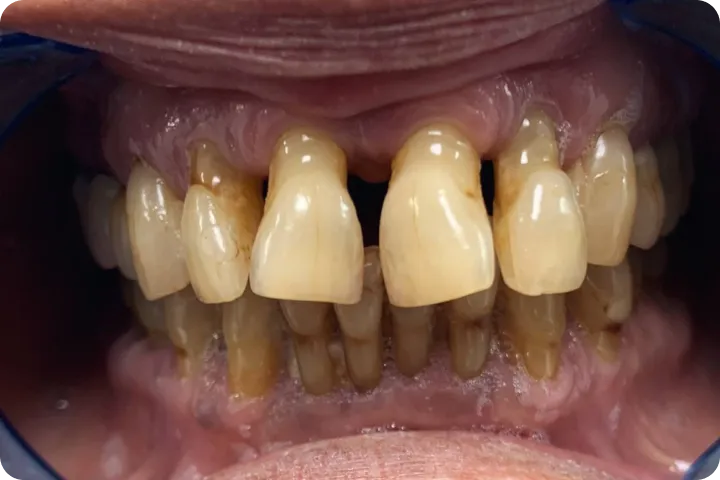 All-on-6 before and after images