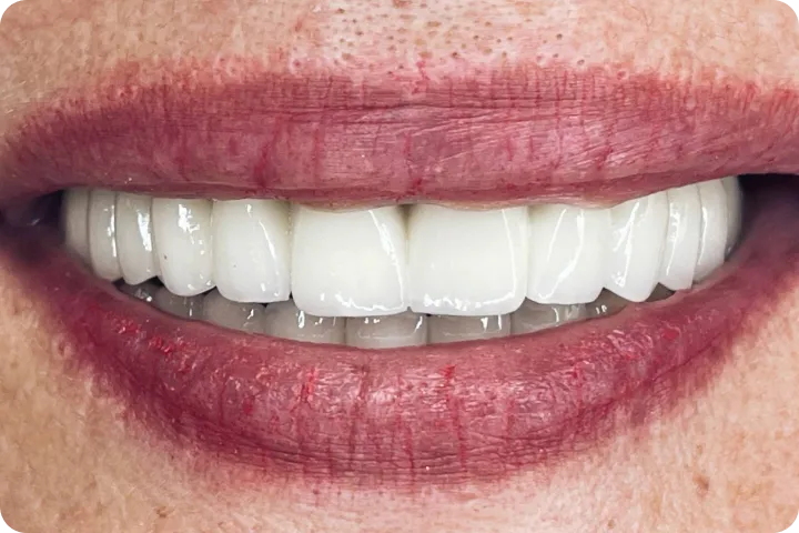 All-on-6 before and after images