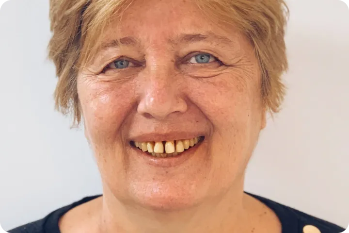 All-on-6 before and after images