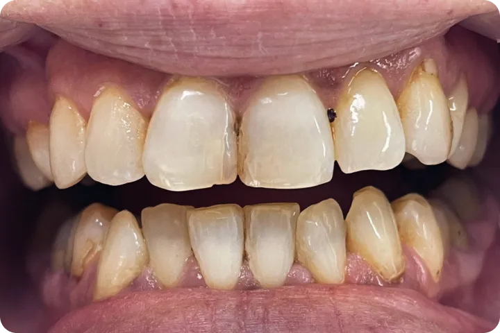 Bezmetalne krunice before and after images