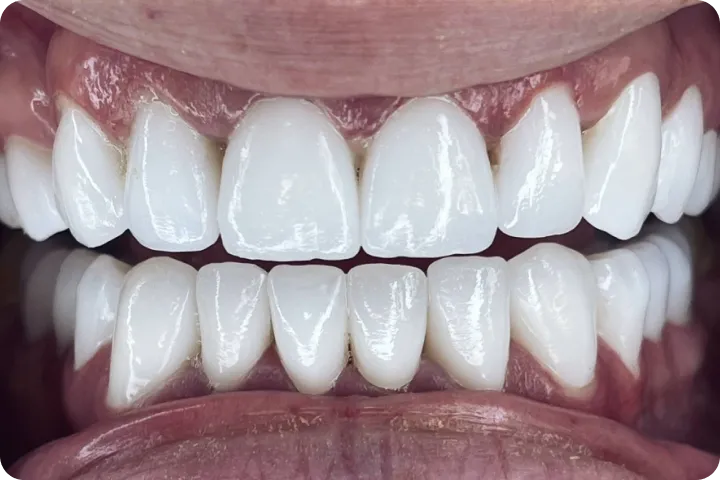 Bezmetalne krunice before and after images