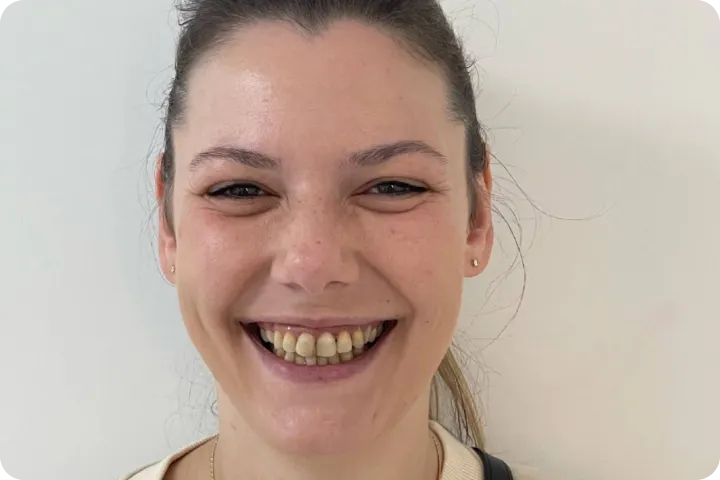 Bezmetalne krunice before and after images