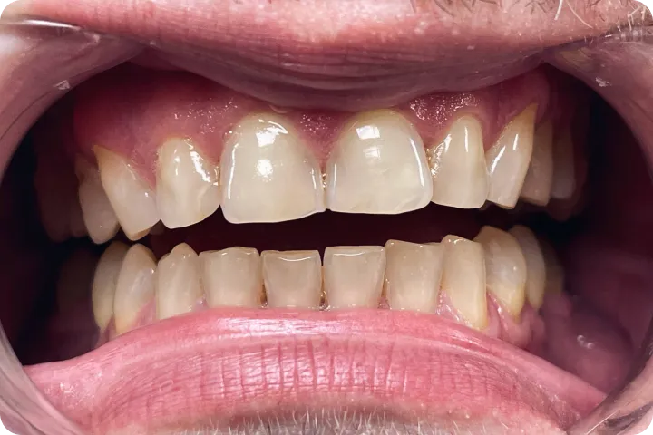 Hollywood smile before and after images