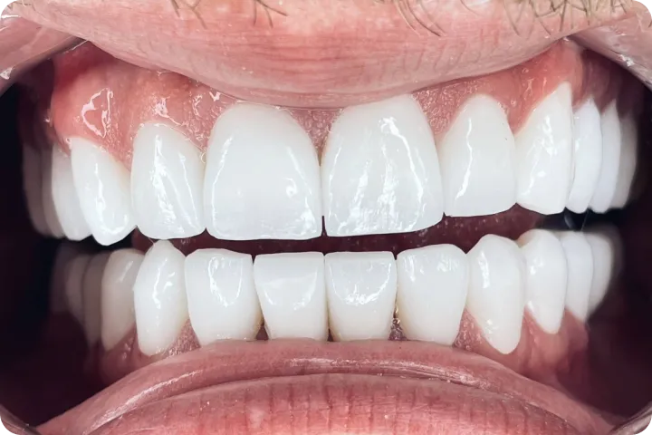 Hollywood smile before and after images