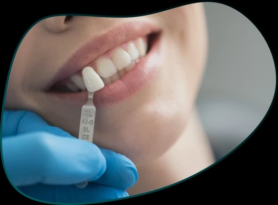 Fasete za zube - viniri