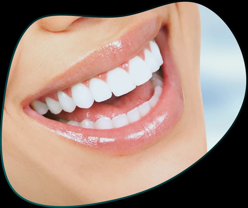 Osoba izbliza Pre i Posle nakon Hollywood smile estetičke stomatološke usluge - holivudski osmeh za blistav osmeh