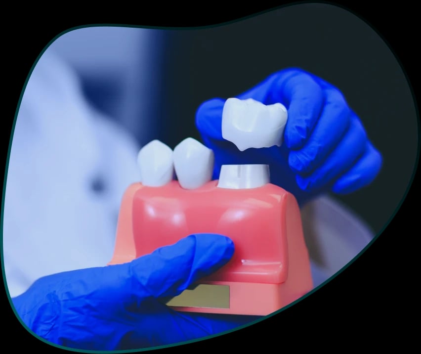 Krunice za zube (Navlake za zube)