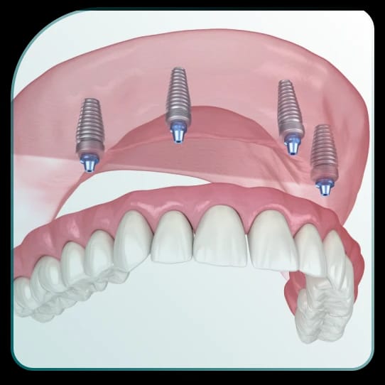 Šta su All on 4 implanti?