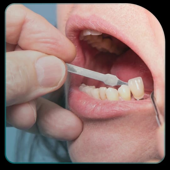 Ugradnja metalo-keramičkih krunica