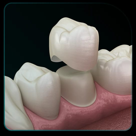 Koje su indikacije za izradu krunica za zube?