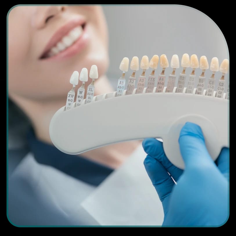 Fasete - viniri - materijali od kojih se prave