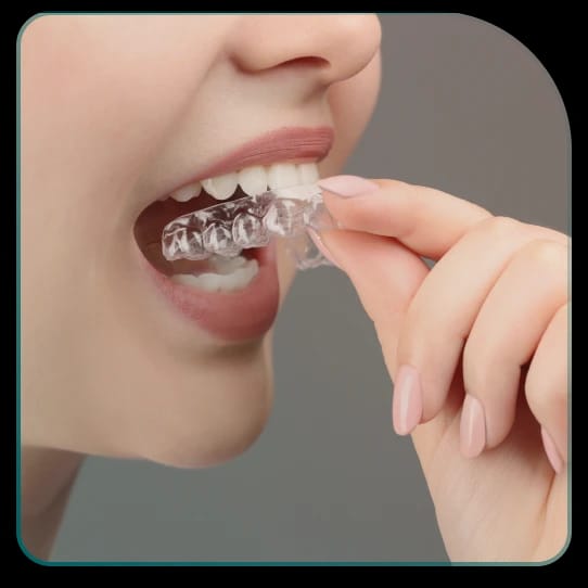 Prednosti aligners terapije?
