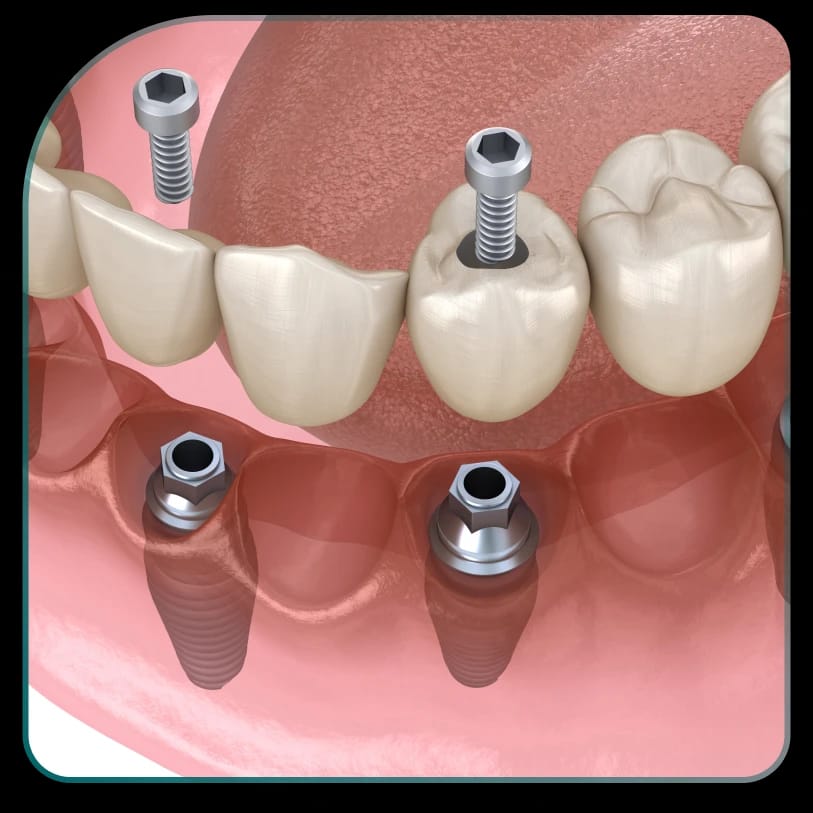 Koliko traje ugradnja implantata zuba?